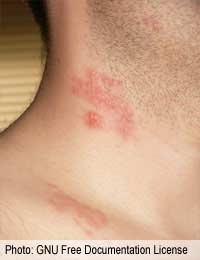 Shingles Back Pain Herpes Varicella