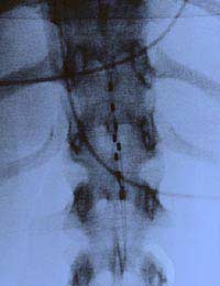 Back Pain Slipped Disc Spinal Vertebrae