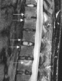 Back Pain Psoriasis Psoriatic Arthritis