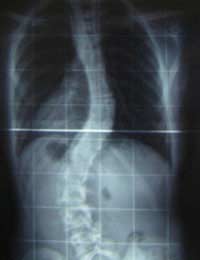 Scoliosis; Idiopathic; Symptomatic;